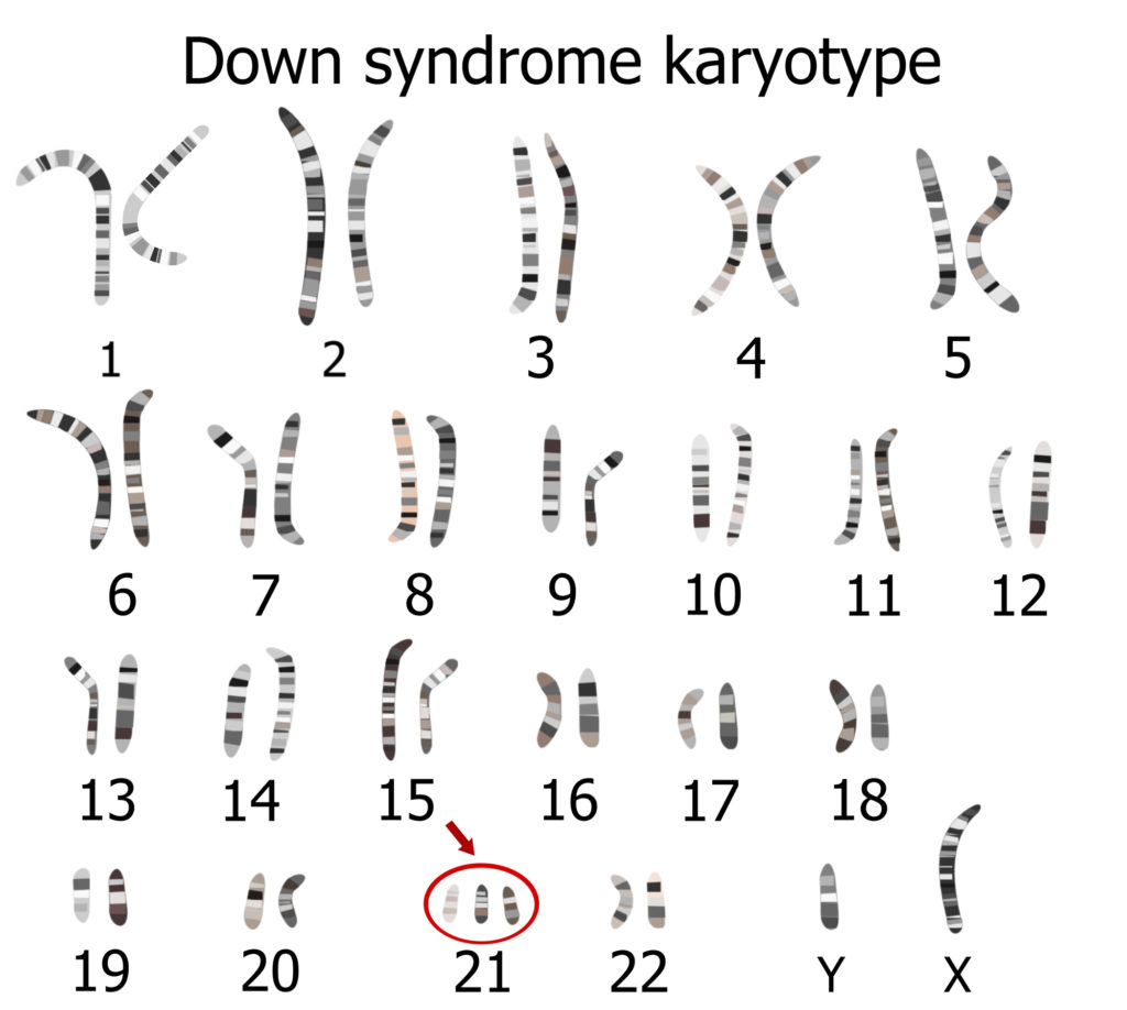karyotype image for Down's syndrome displaying all chromosomes